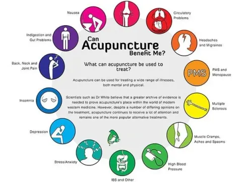 Acupuncture benifits