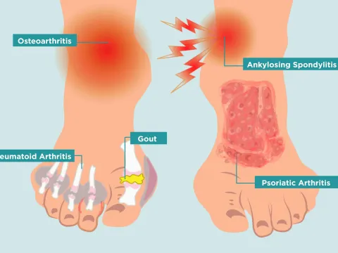 Rheumatology (Arthritis)