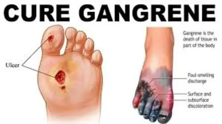 Gangrene