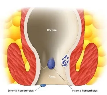 Kshara Karma applied in the treatment of haemorrhoids