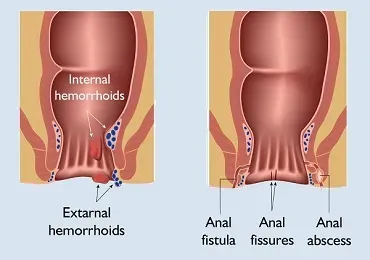 Piles or fissure? How to tell the difference