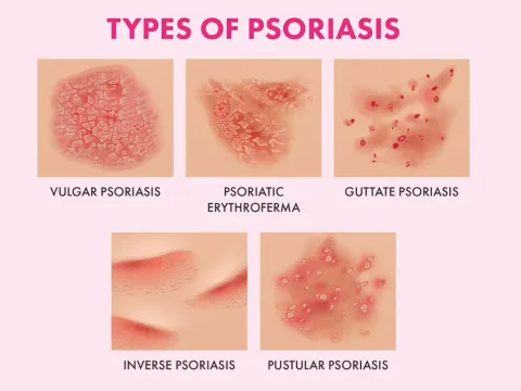 Types of psoriasis