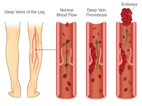 What Is Deep Vein Thrombosis
