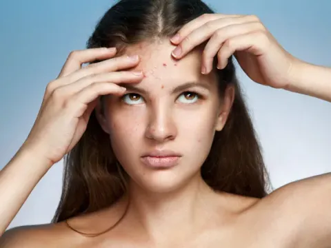 Dermatology Acne