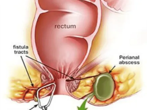 Kshara Sutra thread change during fistula treatment