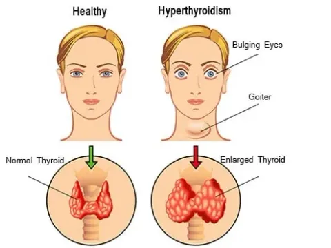Thyroid care at Pranav Ayur Hospitals
