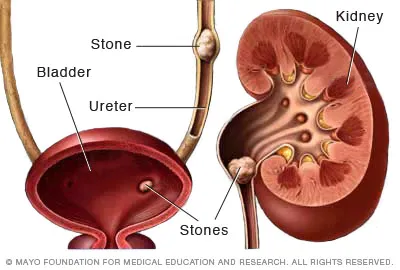 Kidney stones jpg