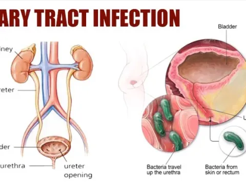 Urinary tract infection