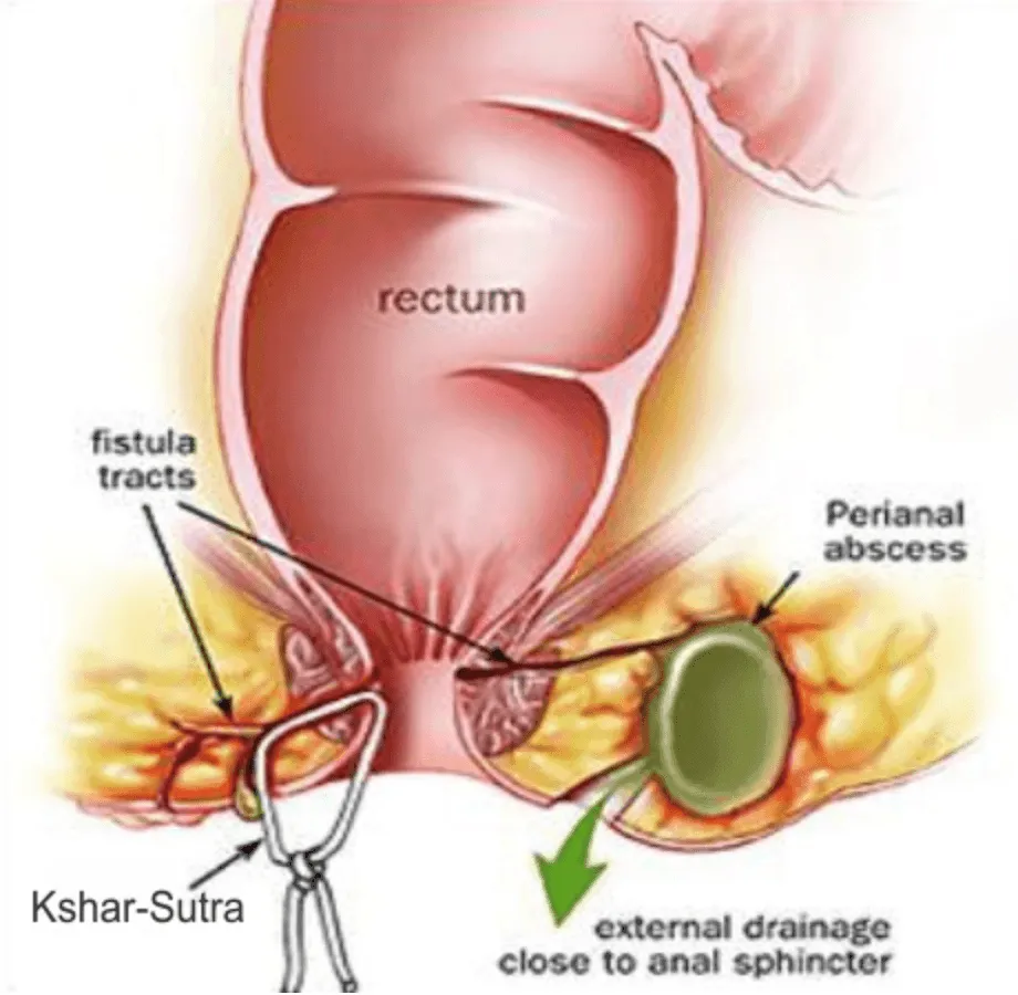 treatment with Kshara Sutra therapy
