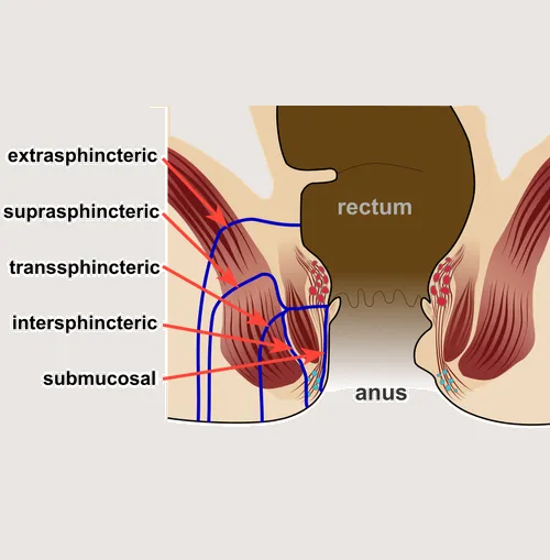 Kshara Sutra therapy for fistula treatment